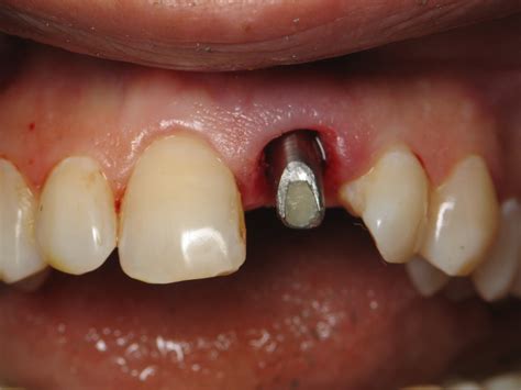 Immediate Front Tooth Dental Implant Example -(Difficult Case) | Ramsey A. Amin, DDS