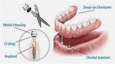 snap-on-dentures | OneSolution Dental Implants