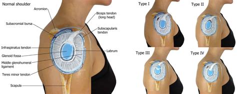 Labrum cartilage tear shoulder, causes, symptoms, diagnosis & treatment