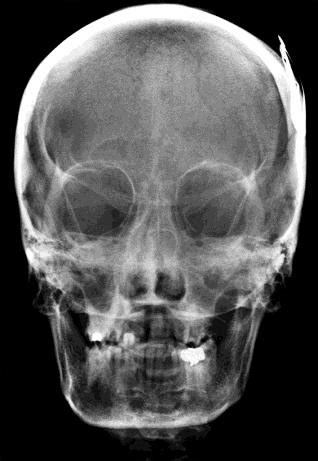 A Caldwell radiograph showing opacification of frontal and ethmoidal ...