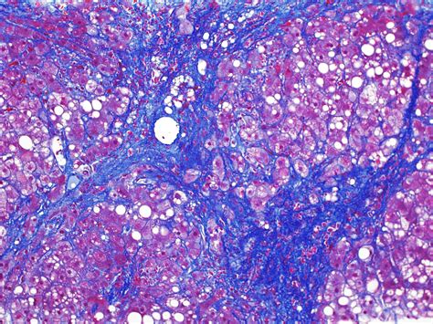 Pathology Outlines - Nonalcoholic fatty liver disease / nonalcoholic ...