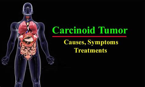 Carcinoid Syndrome - Tumor, Causes, Symptoms, Treatment