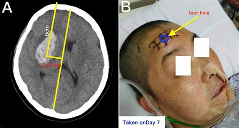 Cureus | Massage of a Hematoma to Assist in Decreasing the Volume of an ...