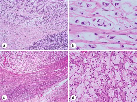 Histology of the signet ring cell adenocarcinoma ((a) H&E stain, 100 ×;... | Download Scientific ...