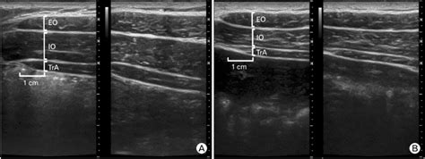 Abdominal Wall Layers Ultrasound