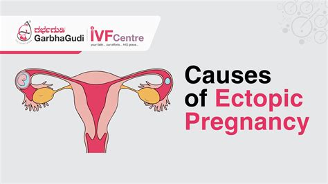 Causes of ectopic pregnancy