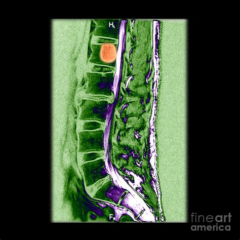 Mri Of Vertebral Hemangioma Photograph by Living Art Enterprises