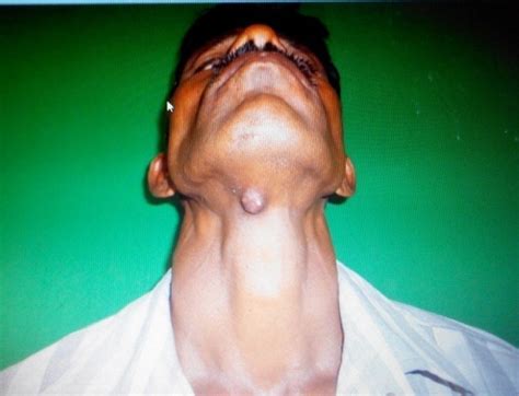 Swelling below the chin | Download Scientific Diagram