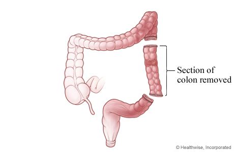 Section of colon removed