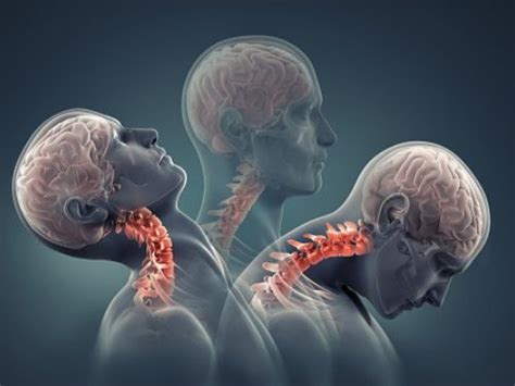 How to Prevent Cervical Lordosis? Causes, Symptoms, Treatment and Exercises