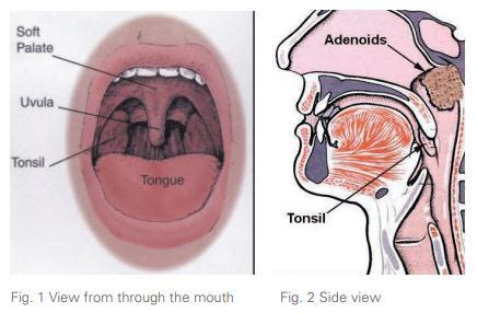 Adenoidectomy (Adenoid Removal): Surgery Recovery, 53% OFF