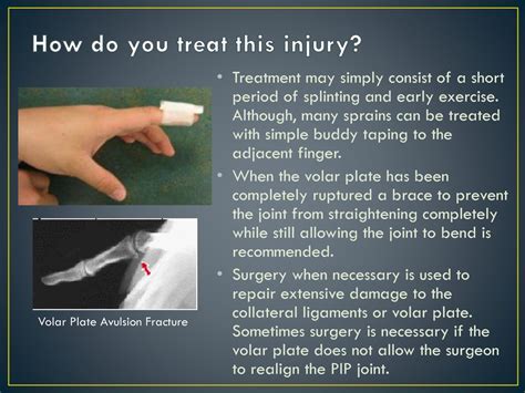 Finger Dislocation of the PIP Joint and Volar Plate - ppt download