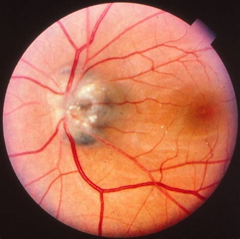 Optic Nerve Melanocytoma - Retina Image Bank