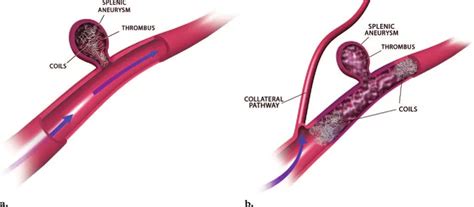 Splenic Artery Embolization (SAE) – Dr Konika