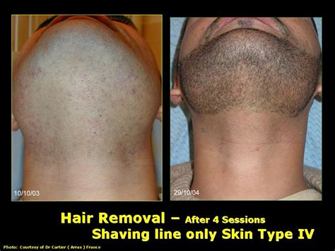 Ipl Laser Hair Removal Before And After - Property & Real Estate for Rent