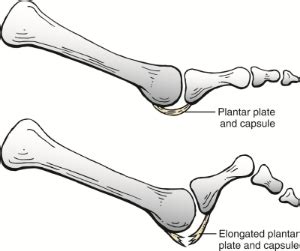 Plantar Plate Tear | Foot & Podiatry Surgery