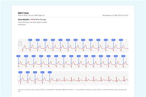 What Accelerated Idioventricular Rhythm Looks Like on Your Watch ECG | Qaly