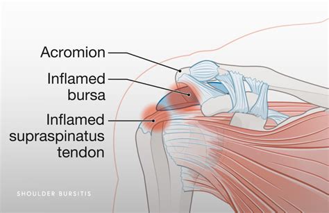 Shoulder Bursitis Schaumburg - Thomas Obermeyer, MD