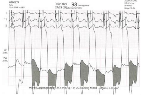 a: invasive haemodynamic assessment of pulmonary artery wedge pressure... | Download Scientific ...