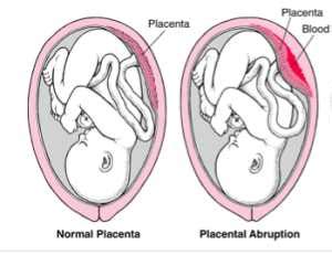 Placental Abruption - MedFriendly.com