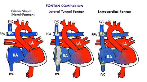 Pin by nonas arc on Single Ventricle Defect | Atrial septal defect, Cardiology, Congenital heart ...