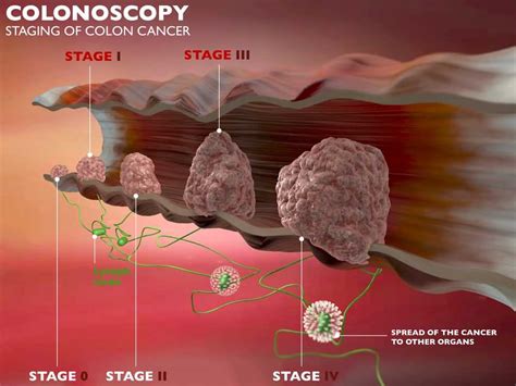 Colon Cancer; Stages, Symptoms, Causes and Screening