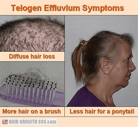 Chronic Telogen Effluvium: Causes Treatments And More | Justinboey