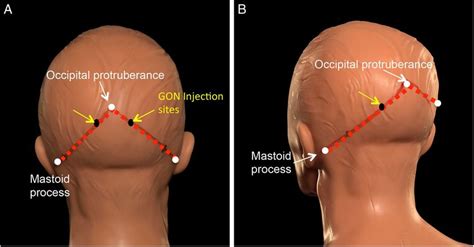 Injection sites for greater occipital nerve (GON) block. The injection ...