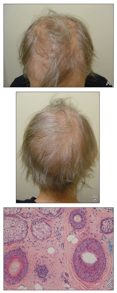 Permanent Alopecia in Breast Cancer Patients: Role of Taxanes and ...