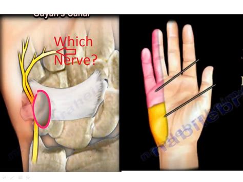 Ganglion Cyst in the Guyon’s Canal — OrthopaedicPrinciples.com