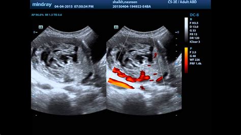 PARTIAL MOLAR PREGNANCY - YouTube