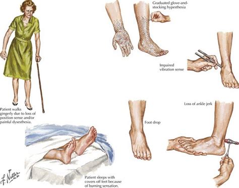 Acquired Polyneuropathies | Neupsy Key