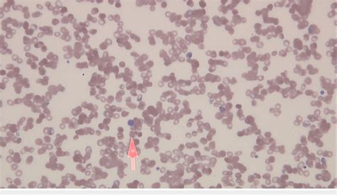 Peripheral blood smear. The peripheral blood smear shows giant ...