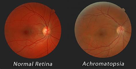 Achromatopsia.info - Reduced Visual Acuity