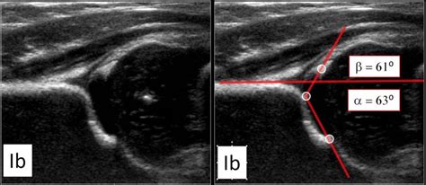 Developmental Dysplasia Of The Hip Ultrasound