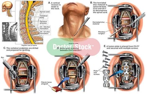 Spine Surgery - C5-6 and C6-7 Anterior Cervical Discectomy with Spinal ...