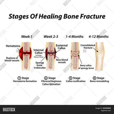 Imagen y foto Stages Healing Bone (prueba gratis) | Bigstock