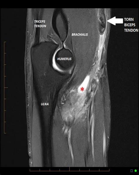 Distal Bicep Tendon Mri