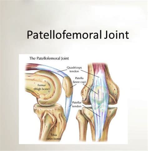 Patellofemoral Syndrome Symptoms & Exercises | Knee Rehab Program