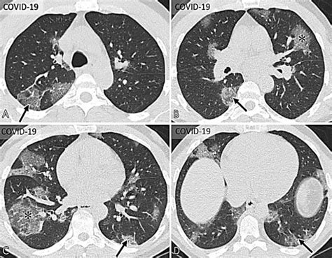 COVID-19 typical chest CT imaging features [7] | Download Scientific Diagram