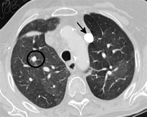 Mosaic Attenuation: Etiology, Methods of Differentiation, and Pitfalls | RadioGraphics