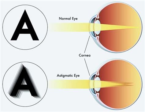 Lazy Eye (Amblyopia) Treatment · Eye Specialist · NYC Ophthalmologist