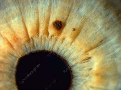 Iris Nevus - Stock Image - C027/2067 - Science Photo Library