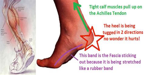 This ONE Stretch Relieves Plantar Fasciitis, Shin Splints, Achilles ...