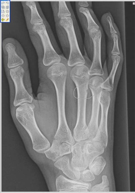 Fibrous Cortical Defect Metacarpal - Sumer's Radiology Blog