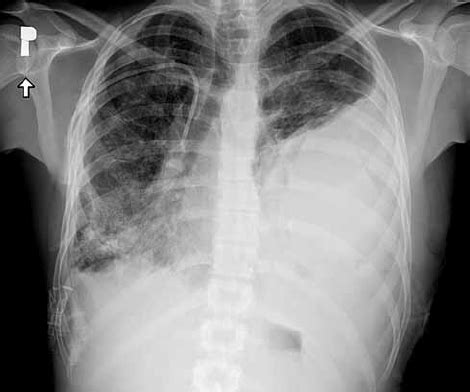 Left Hemothorax X Ray