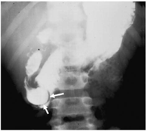 Esophagus and Gastrointestinal Tract | Radiology Key