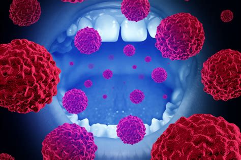 What Do The Early Stages Of Mouth Cancer Look Like?