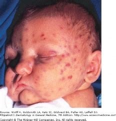 Cytomegalovirus (CMV) Infection - Physiopedia