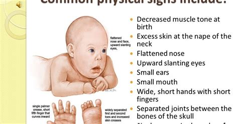 Dua Kali Down Syndrome Anugerah Tuhan: Down Syndrome (Trisomy 21)